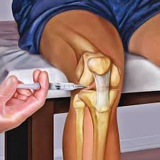 O que fazer logo após a Infiltração de Joelho?